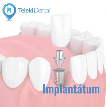 Implantológia